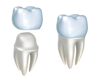 diagram showing how a dental crown is placed