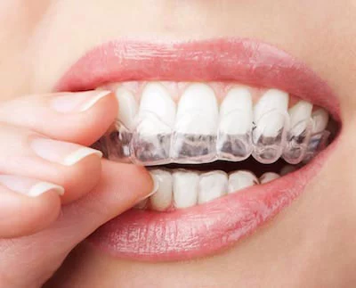 patient using a teeth whitening tray