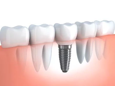 diagram showing how a dental implant is placed between other teeth