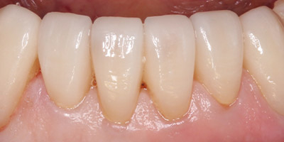 After image