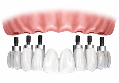 diagram showing how dental implants can restore an entire set of teeth