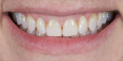 After image