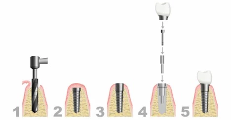 the different steps of the dental implant process