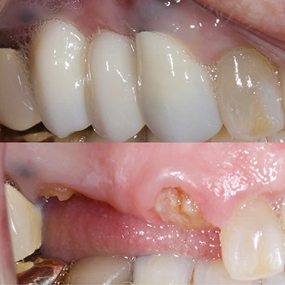 images showing how an implant supported bridge restored a patient's smile