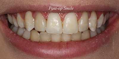 After image