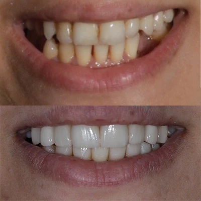 a patient smiling before and after dental implants restored their smile