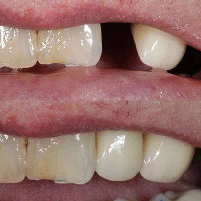 a patient's smile before and after getting a dental implant