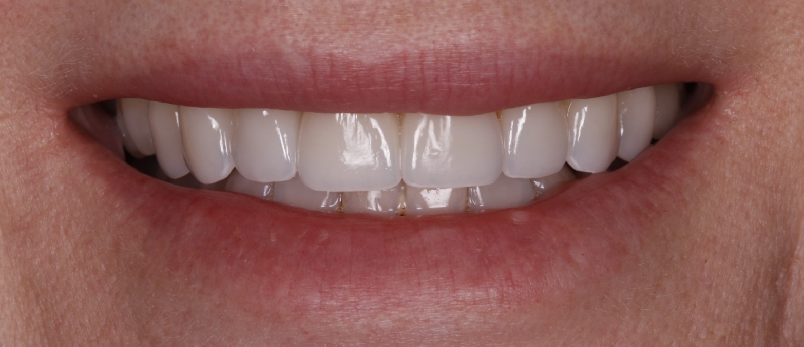 After image